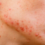 Vital Health Inc Provides Tips On How To Combat Cystic Acne Through