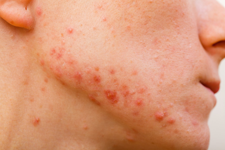 Vital Health Inc Provides Tips On How To Combat Cystic Acne Through 