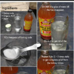 How To Get Rid Of Kidney Stones Using Baking Soda