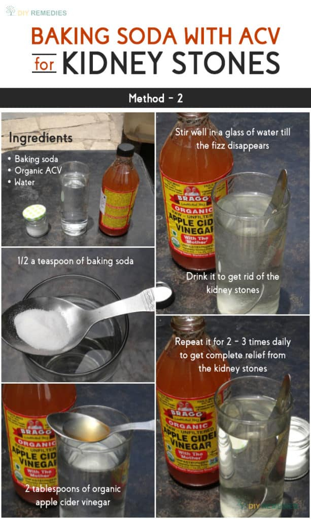 How To Get Rid Of Kidney Stones Using Baking Soda